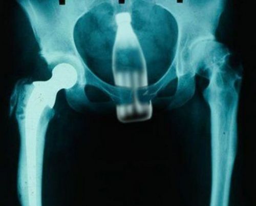 Картинка с рентгеновской фотографией бутылки во влагалище. эротическая картинка прикол